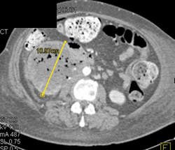 Renal Abscess - CTisus CT Scan