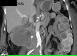 Renal Abscess - CTisus CT Scan