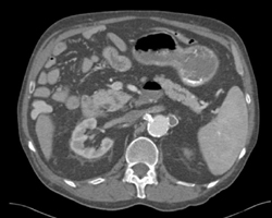 Renal Artery Aneurysm - CTisus CT Scan