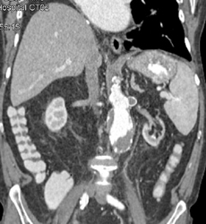 Renal Artery Aneurysm - CTisus CT Scan