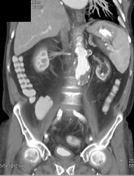 Renal Artery Aneurysm - CTisus CT Scan