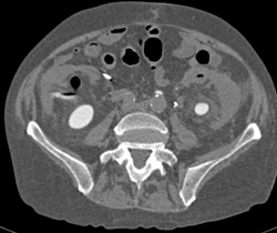 Peri Renal ?? on the Left - CTisus CT Scan