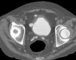 Ct Cystogram With Bladder Diverticulum - CTisus CT Scan