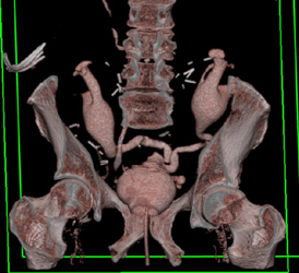 Ct Urogram With Bilateral Renal Transplants - CTisus CT Scan