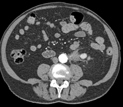 Retroperitoneal Fibrosis Encases the Left Mid-ureter - CTisus CT Scan