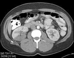 Renal Infarct - CTisus CT Scan