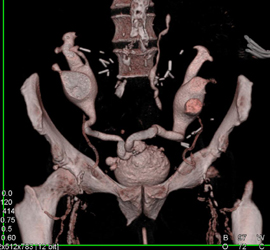 Ct Urogram of Transplants - CTisus CT Scan