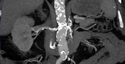 Renal Artery Stenosis - CTisus CT Scan