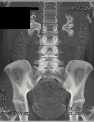 Normal CT Urogram - CTisus CT Scan