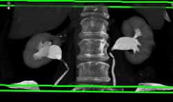 Ct Urogram - CTisus CT Scan