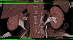 Ct Urogram - CTisus CT Scan