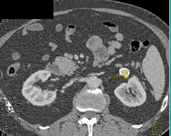 Renal Artery Aneurysm - CTisus CT Scan