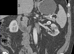 Renal Artery Aneurysm - CTisus CT Scan