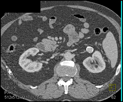 Renal Artery Aneurysm - CTisus CT Scan