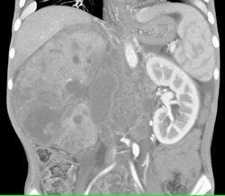 Medullary Carcinoma With Bulky Nodes - CTisus CT Scan