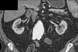 Bladder Cancer Seen on Multiple Phases - CTisus CT Scan