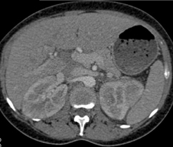 Acute Bilateral Pyelonephritis - CTisus CT Scan