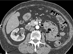 Left Nephrectomy - CTisus CT Scan