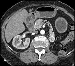 Metastatic Renal Cell Carcinoma in the Tail of the Pancreas - CTisus CT Scan