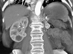 Pancreatic Metastases and New Renal Cell Carcinoma (RCC) - CTisus CT Scan