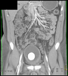 Calcification of A Suprapubic Tube and Its Tract - CTisus CT Scan