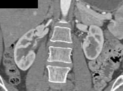 Multiple Renal Arteries - CTisus CT Scan