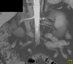 Multiple Renal Arteries - CTisus CT Scan