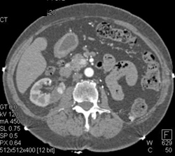 Cystic Renal Cell Carcinoma (RCC) - CTisus CT Scan