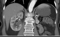 Cystic Renal Cell Carcinoma (RCC) - CTisus CT Scan