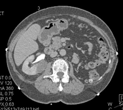 Cystic Renal Cell Carcinoma (RCC) - CTisus CT Scan