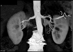 Fibromuscular Dysplasia - CTisus CT Scan