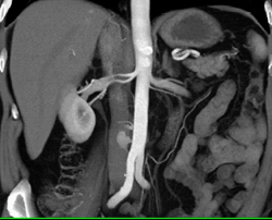 Prehilar Branching of the Right Renal Artery and the Left Renal Artery. A Second Left Renal Artery Is Also Seen - CTisus CT Scan