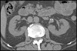 Left Renal Artery Aneurysm - CTisus CT Scan