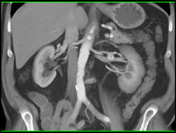 Left Renal Artery Aneurysm - CTisus CT Scan