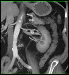 Left Renal Artery Aneurysm - CTisus CT Scan