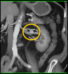 Left Renal Artery Aneurysm - CTisus CT Scan