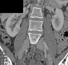 Subtle 1 Cm Carcinoma Medial Aspect of Lower Pole Right Kidney - CTisus CT Scan