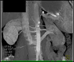 Multiple Renal Arteries - CTisus CT Scan