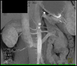 Multiple Renal Arteries - CTisus CT Scan