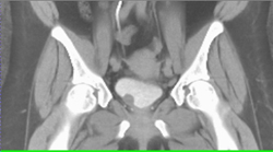 Bladder Cancer - CTisus CT Scan