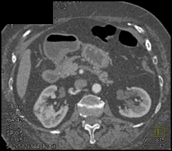 Renal Cell Carcinoma - CTisus CT Scan