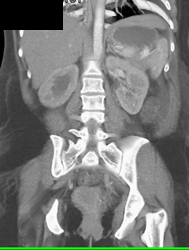 Pregnancy Obstructs the Right Ureter-pregnant Uterus - CTisus CT Scan