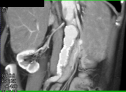 Renal Artery Stenosis - CTisus CT Scan