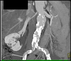 Renal Artery Stenosis - CTisus CT Scan