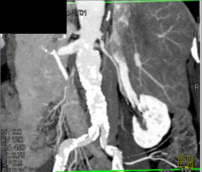 Renal Artery Stenosis - CTisus CT Scan