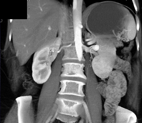 Left Renal Artery Aneurysm - CTisus CT Scan