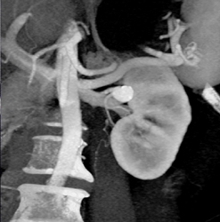 Left Renal Artery Aneurysm - CTisus CT Scan