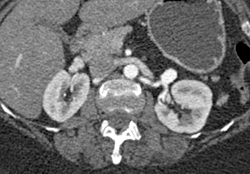 Left Renal Artery Aneurysm - CTisus CT Scan