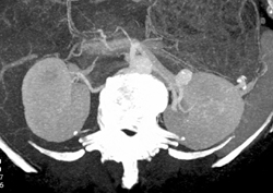 Left Renal Artery Aneurysm - CTisus CT Scan