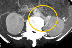 Left Renal Artery Aneurysm - CTisus CT Scan